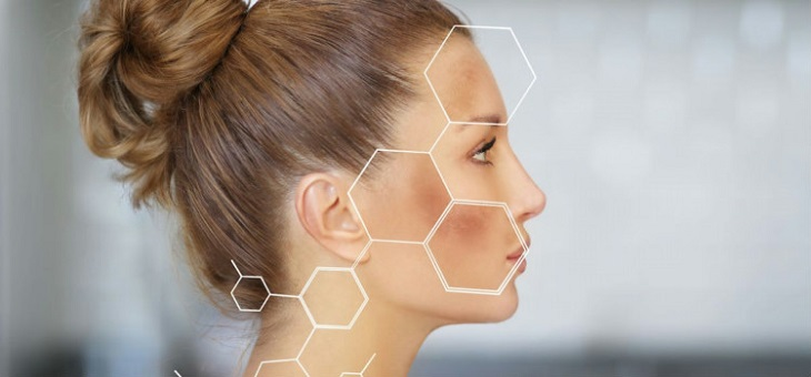 side profile of woman's face with dark patches of skin