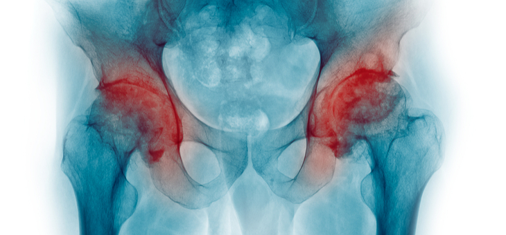 What is osteoporosis and why does it matter? Can you reverse it?