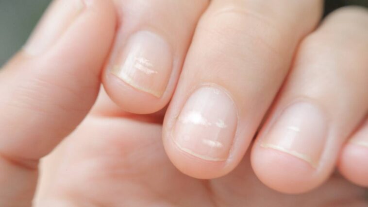 Nails with white spots