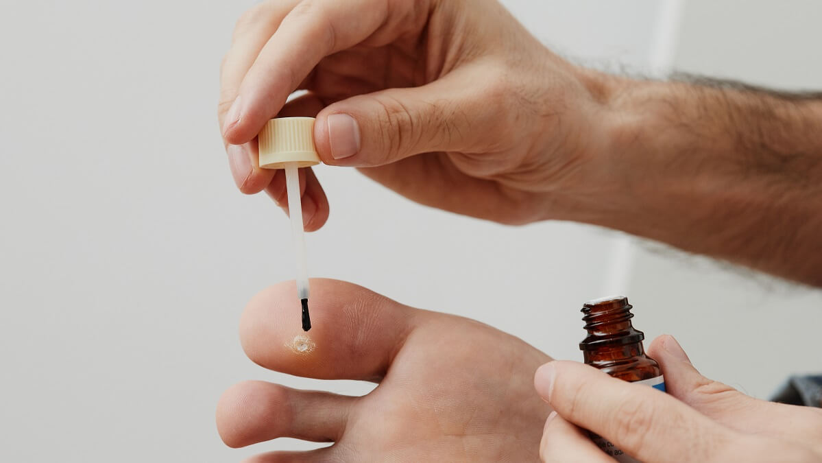 person applying wart remedy to toe