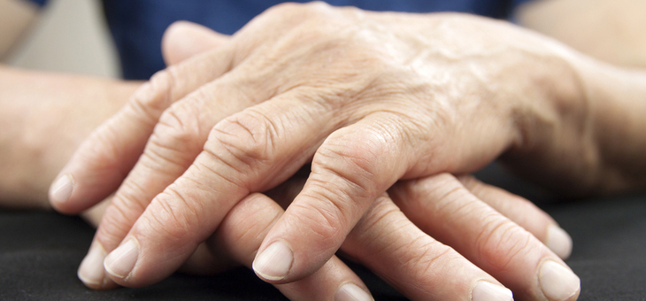 Gut feeling: Scientists discover unusual arthritis link