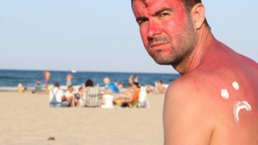sunburnt man sitting on beach with frowny face of sunscreen on back