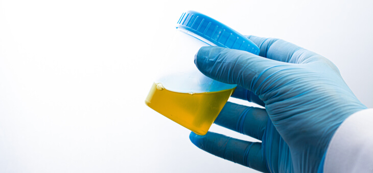 gloved hand holding urine sample in jar