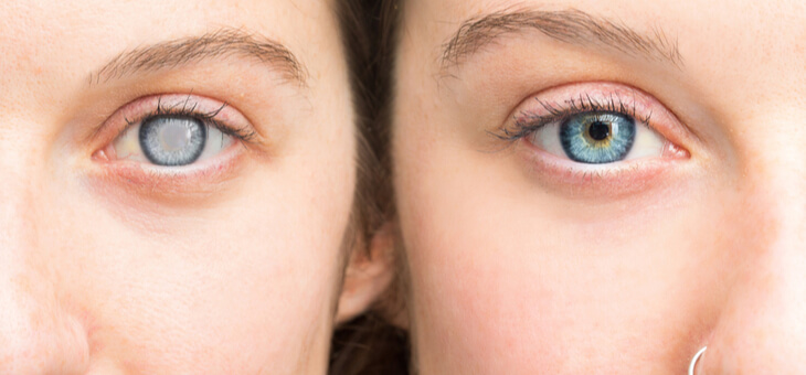 eyes of two women side by side one with cataracts one without