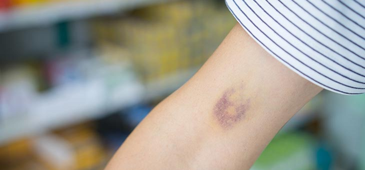 person with bruises on their arm