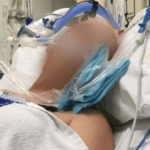 stroke victim in hospital bed with face blurred out
