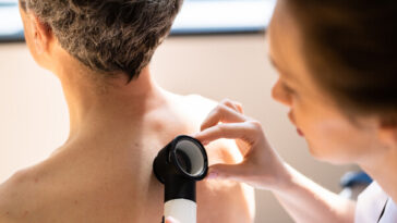 man having mole on back examined by dermatologist