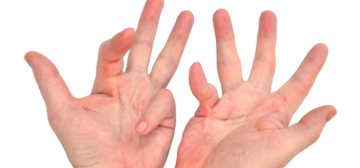 finger with rheumatoid arthritis