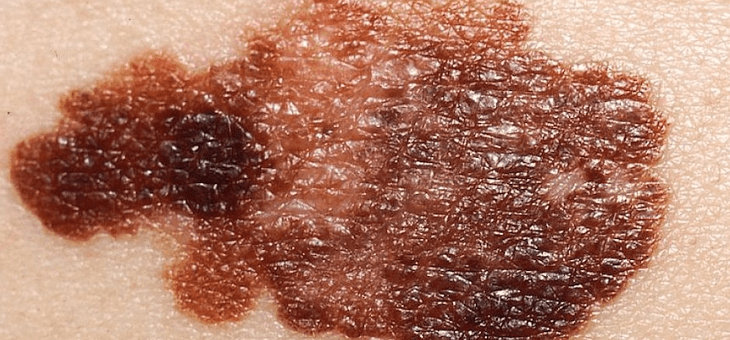 close up of melanoma on skin
