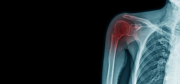 xray showing damaged shoulder joint pain