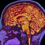 early-onset dementia shown in brain scan