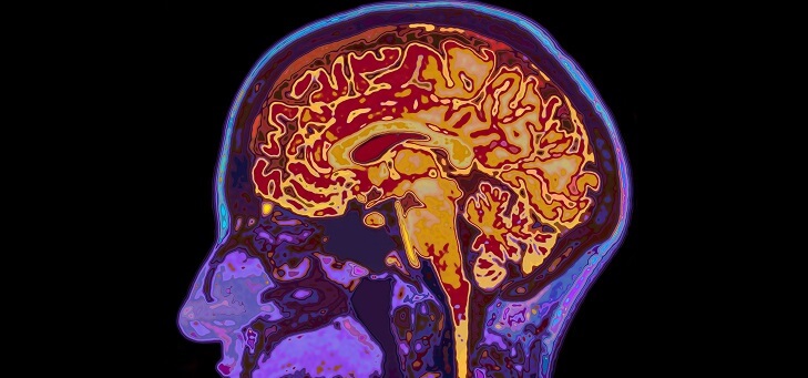early-onset dementia shown in brain scan