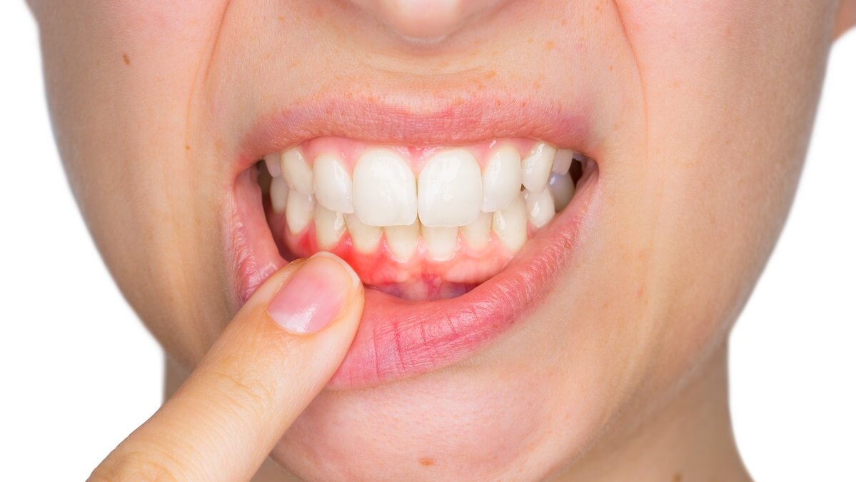 woman with gum disease