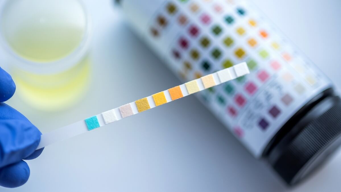 urine test for cancer
