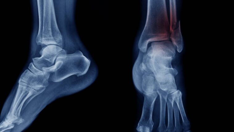 x-ray of feet