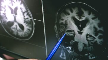 doctor looking at brain changes in x-ray