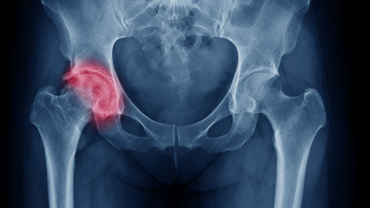 x-ray print of hip fracture