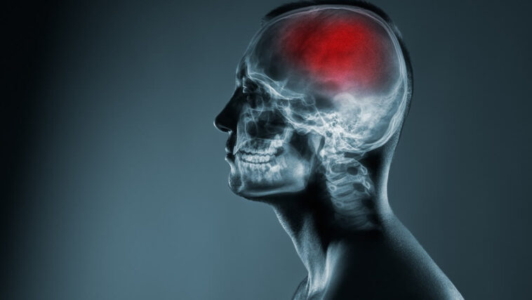 Brain Image of a stroke