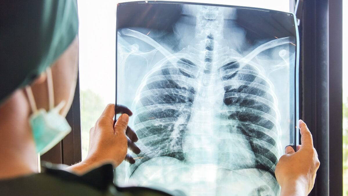 doctor looking at chest x-ray of patient with tuberculosis