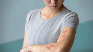 woman who needs shingles vaccine