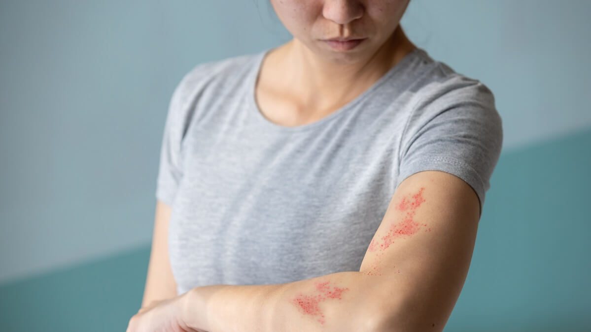 woman who needs shingles vaccine