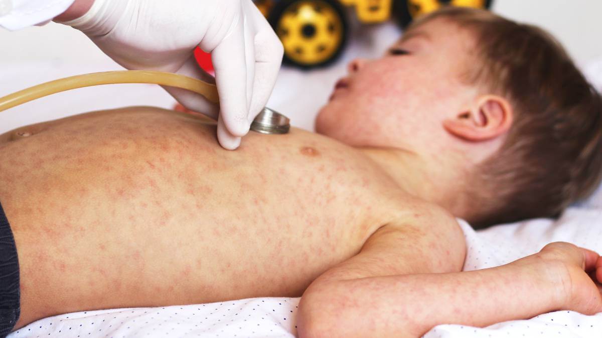A little boy with measles