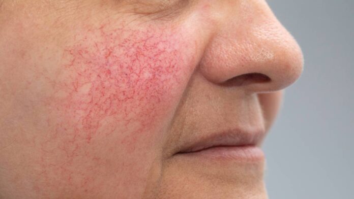 A woman suffering from rosacea