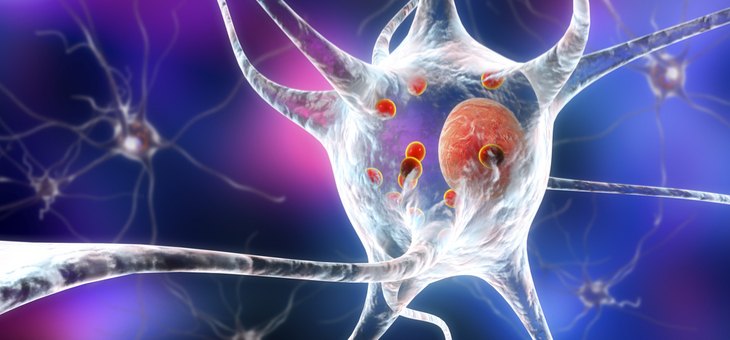 Researchers make important Parkinson’s breakthrough