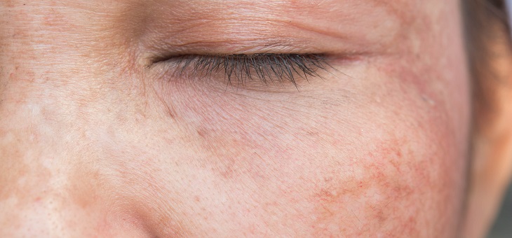 Fade age spots with these eight homemade remedies