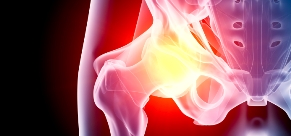 Covering the cost of joint replacement surgery