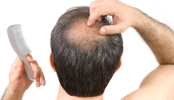 Going bald? There's no need to panic
