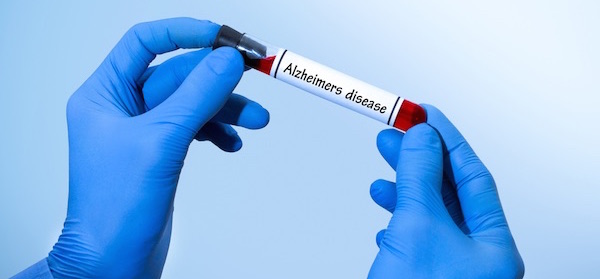 gloved doctors hands holding blood test for alzheimers