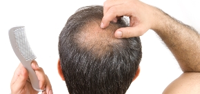 Link between male baldness and heart attack