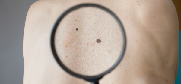 New drug helps fight melanoma